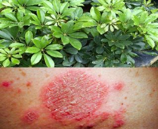 Bài thuốc chữa bệnh Eczema từ cây ngũ gia bì
