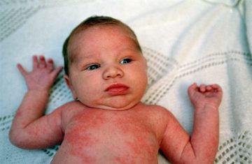 Bệnh Eczema ở trẻ sơ sinh và những điều cần biết