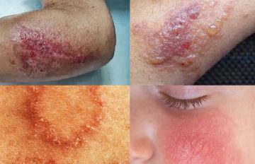 Điểm mặt các nguyên nhân gây bệnh Eczema