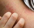 Bệnh Eczema ảnh hưởng đến làn da như thế nào?