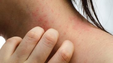 Bệnh Eczema ảnh hưởng đến làn da như thế nào?