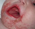 Viêm da mủ ở trẻ sơ sinh – Triệu chứng và cách điều trị