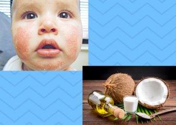 Cách chữa bệnh chàm sữa bằng dầu dừa cực an toàn cho bé