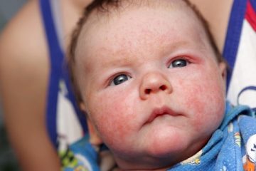 Trẻ sơ sinh bị chàm sữa và những điều mẹ nên biết