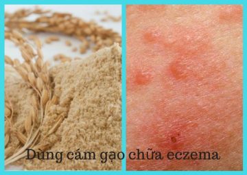 Cách dùng cám gạo chữa bệnh eczema đơn giản tại nhà
