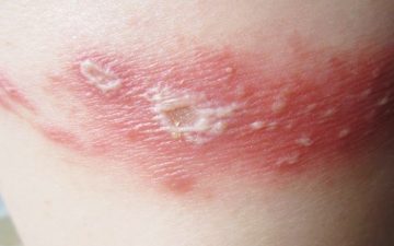 Bị viêm da do kiến độc cắn điều trị như thế nào