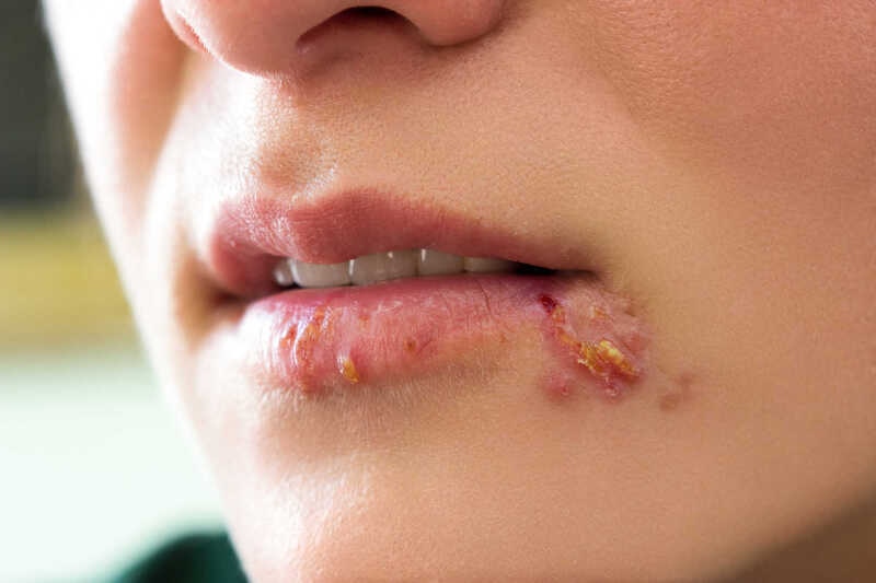 Thuốc sinh học có thể gây Herpes miệng